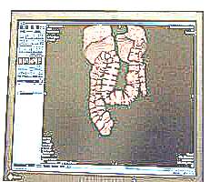 Виртуальная колоноскопия кишечника